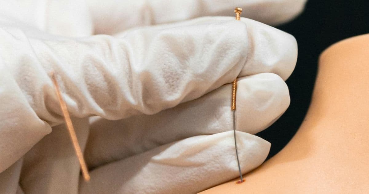 إبر دقيقة داخل العضلات.. ماذا نعرف عن العلاج بالإبر الجافة؟