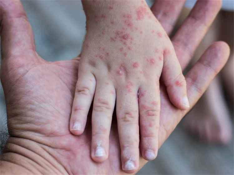 أكثر من 12.8 ألف إصابة بالحصبة و71 وفاة خلال 5 أشهر في اليمن